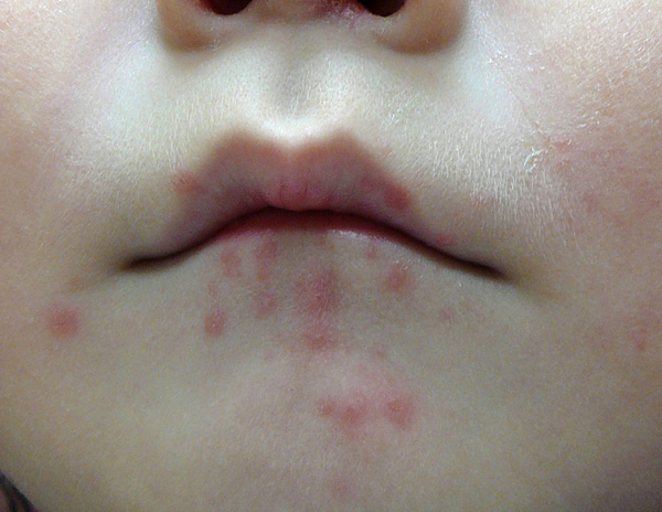 これまでで最高の子供 口の周り 湿疹 アレルギー かわいい子供たちの画像